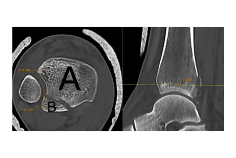 Måling notchinvolovering av posterolateralt fragment 5 mm over tibia plafonden.