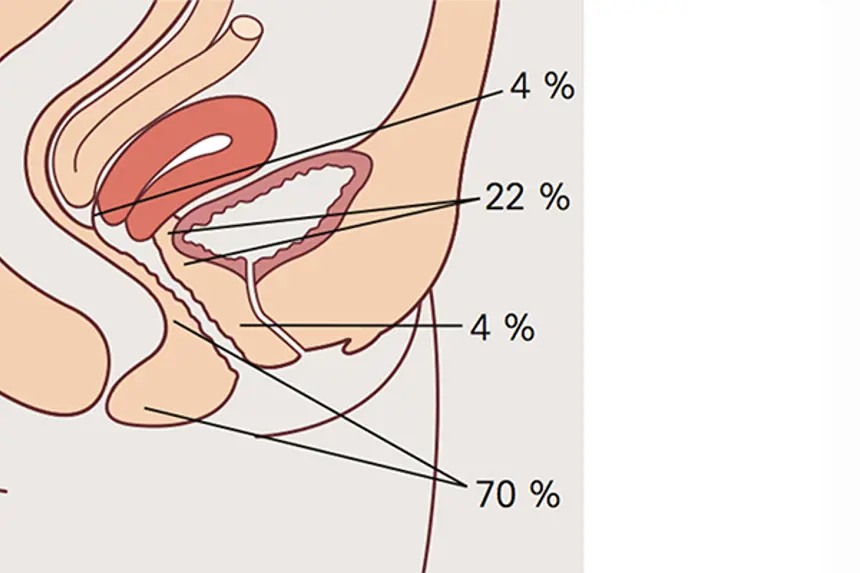 Tegningen viser hvor i underlivet fistler oppstår og prosentvis fordeling.