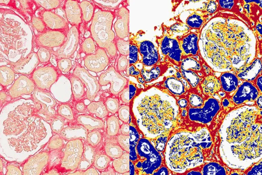 Kidney fibrosis