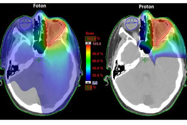 Sammenligning tradisjonell strålebehandling (til venstre) og protonbehandling (til høyre) av hodet