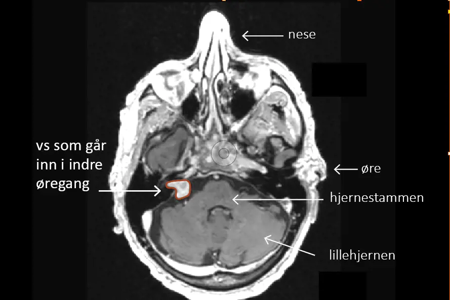 MR bilde av pasient med tekstforklaring, svulst på balansenerven, indre øregang, hjernestamme, lillehjernen, øre, nese.