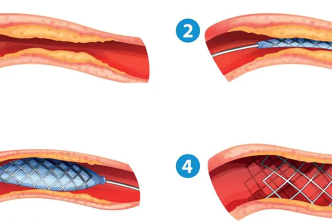 stent illustrasjon