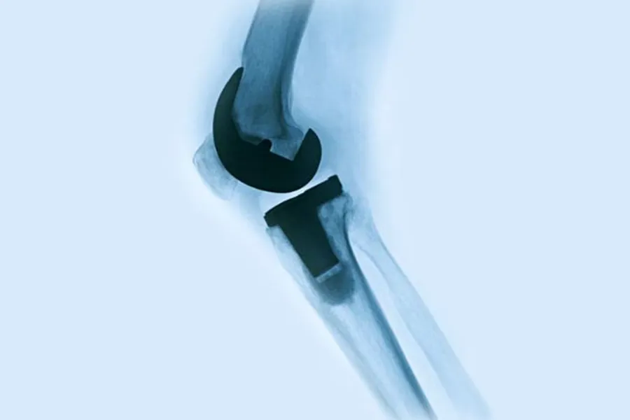 kneprotese